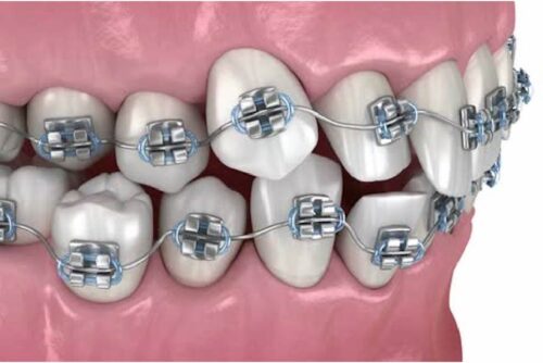 orthodontics Treatments