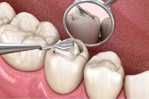 Filling Treatment in Uttara