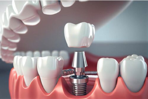 IMPLANT