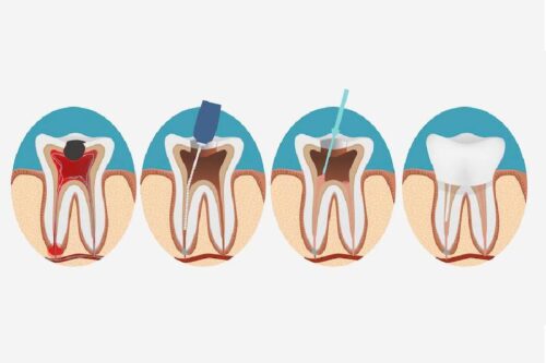 Root canal Treatment in Uttara
