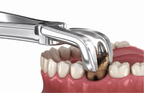 tooth extraction Treatment in Uttara