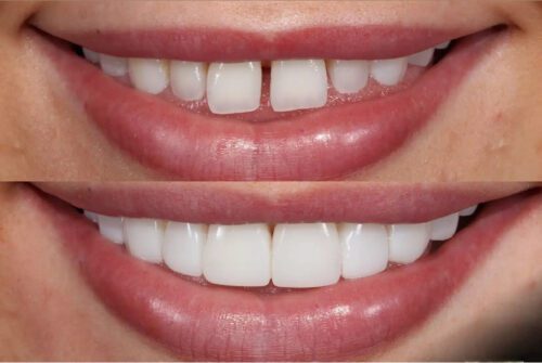 Veneers Treatment in Uttara