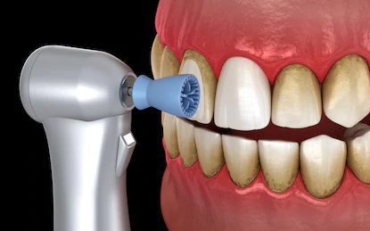 dental-scaling-and-polishing