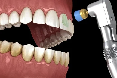 teeth-polishing-procedure-professional-brush