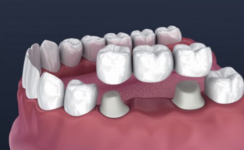 dental-crowns-and-bridges