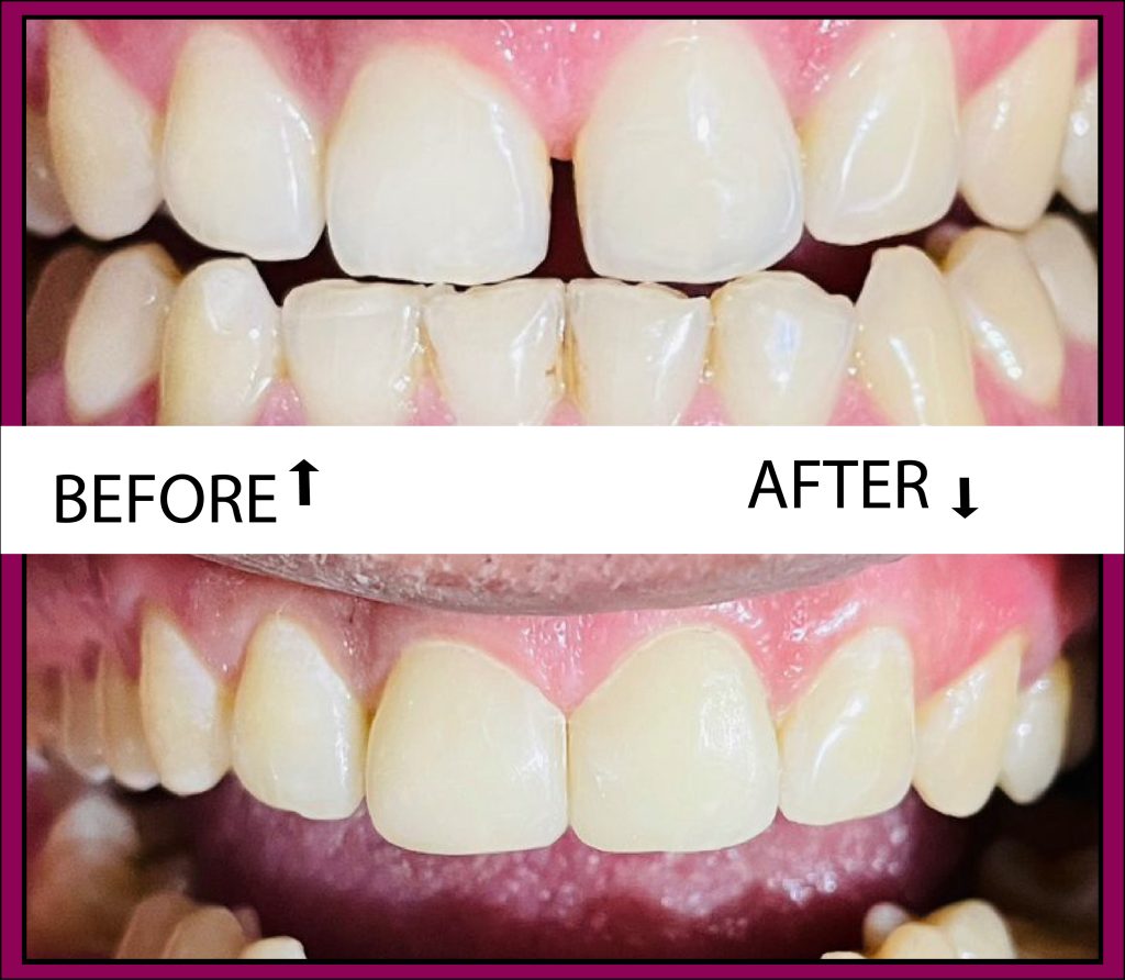 gap teeth before after