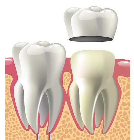 dental Crown treatments