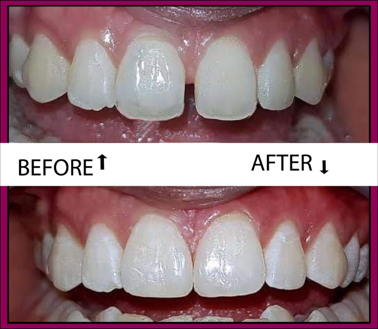 gap teeth before after
