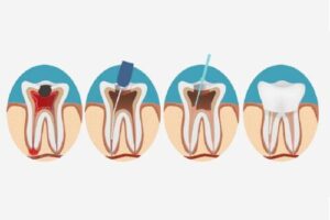 Root-Canal-Treatment-1