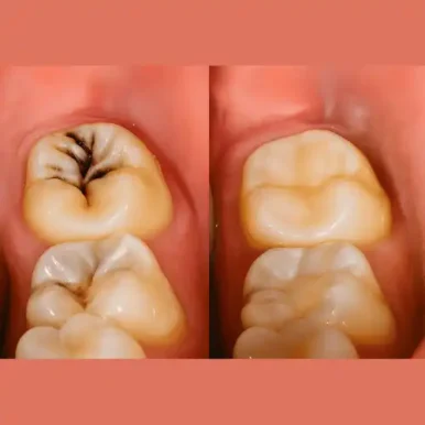 Composited filling before after (1)