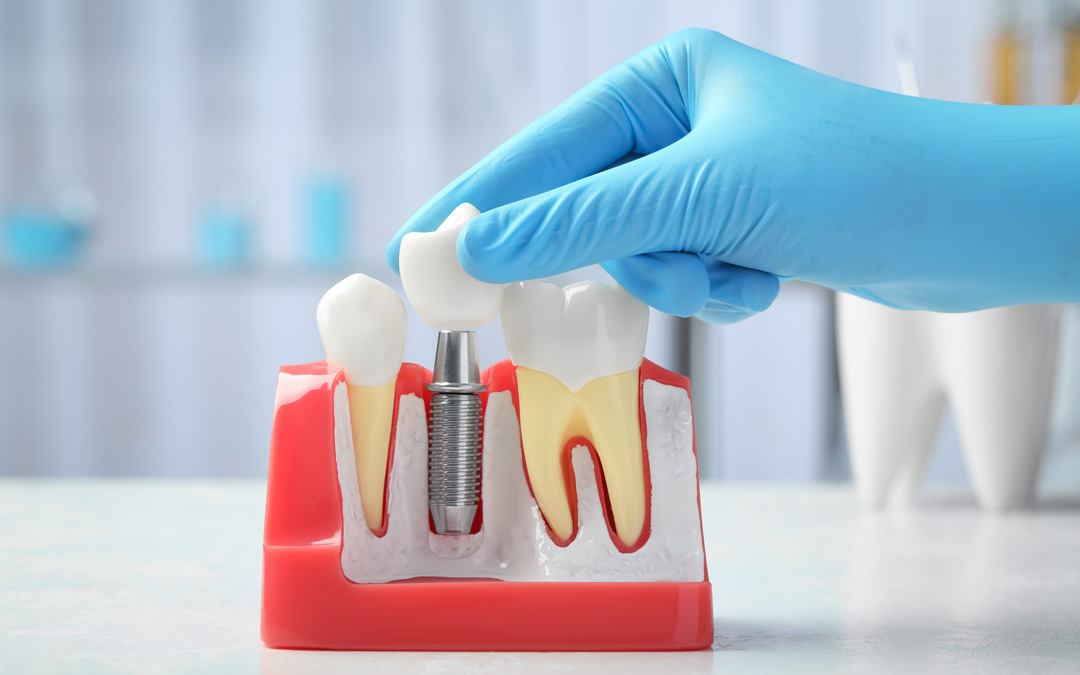 Intra Oral Camera - Tech Dental Care