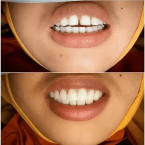 gap teeth before after (2)