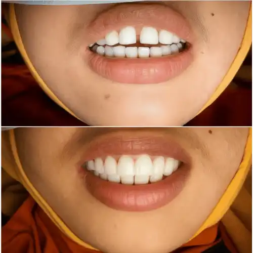 gap teeth before after (2)