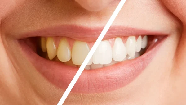 Before and After Scaling Polishing