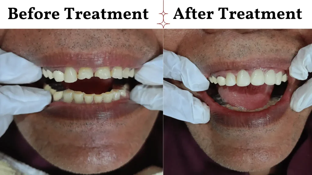Case-Study-Aesthetic-Rehabilitation-via-Direct-Composite-Veneers