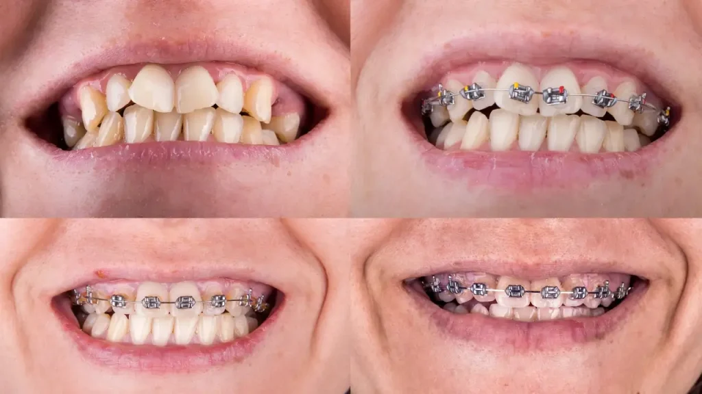 Orthodontic-Correction