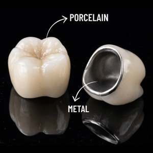 Porcelain Crown