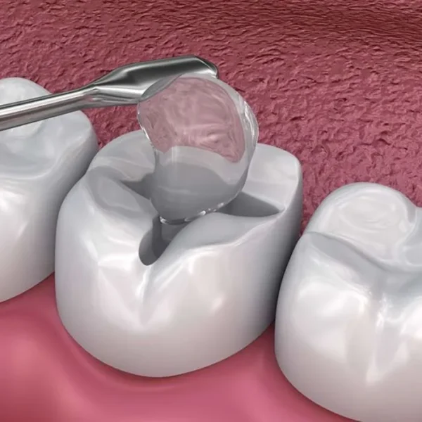 Composite Dental Filling Procedure