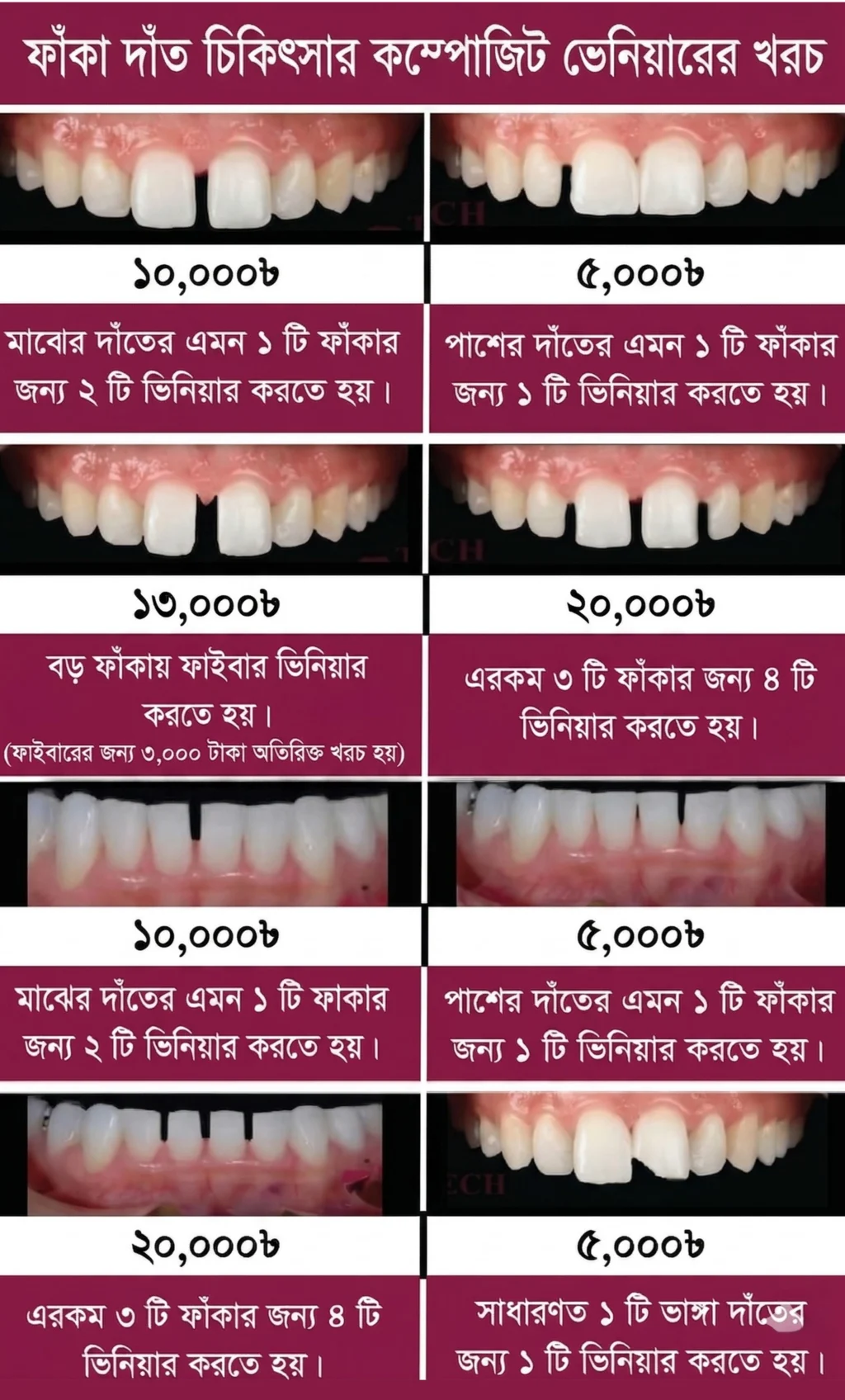 An infographic showing the cost of Direct Composite Veneer treatments for different dental cases. It displays prices ranging from 5,000 BDT to 20,000 BDT for filling gaps between teeth, fiber-reinforced veneers for large gaps, and repairing broken teeth.