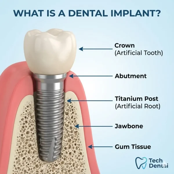 Dental Implant Procedure