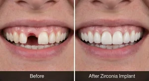 Before and after photos showing a patient's smile with a missing front tooth and then with a new Zirconia dental implant.