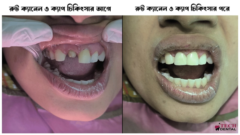 Root Canal Treatment