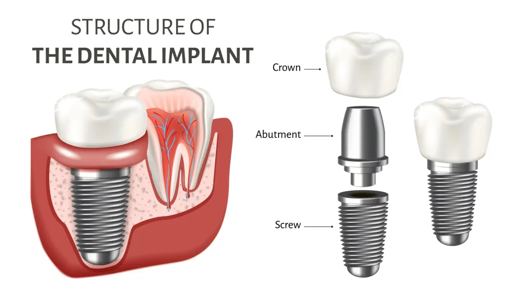 implant