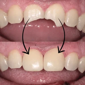 Broken Teeth Treatment