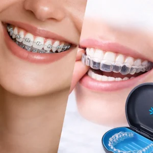 Orthodontic Treatment