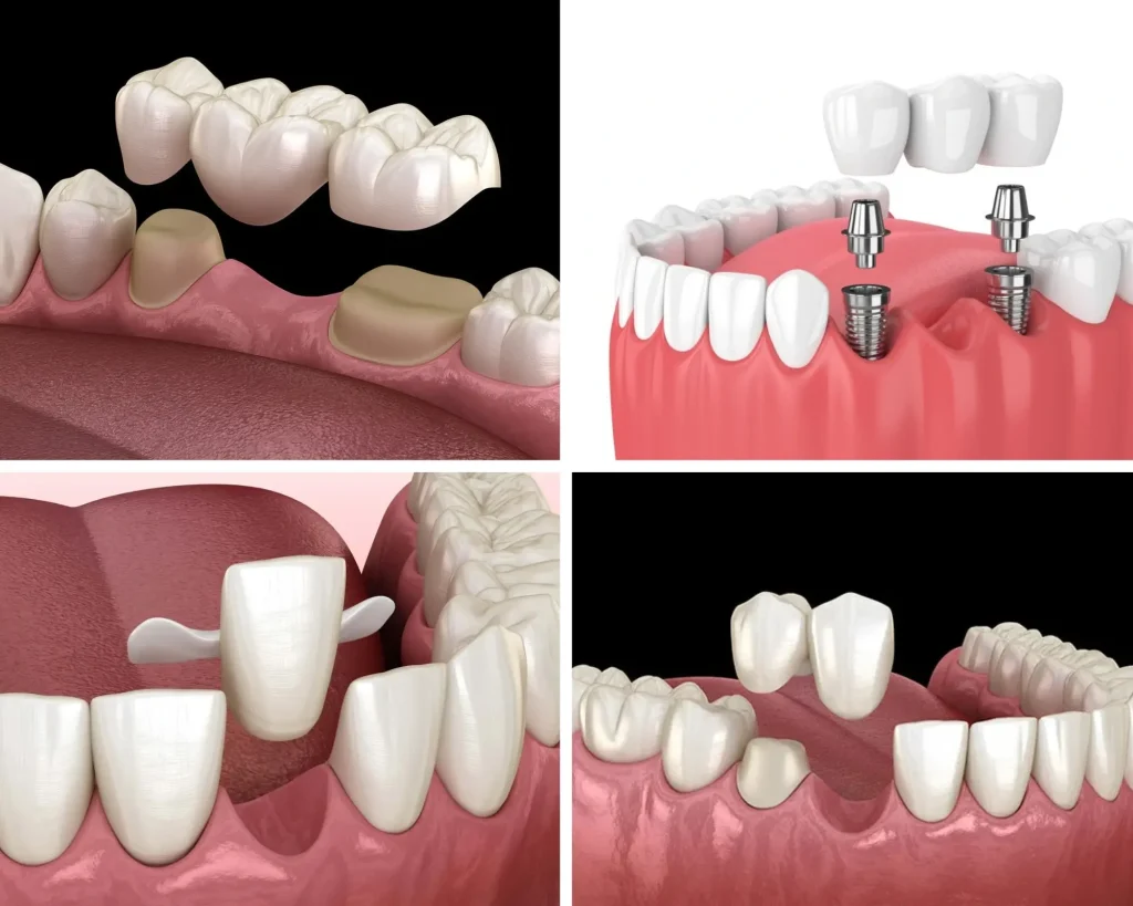A detailed four-panel medical illustration showcasing different dental bridge procedures: Top Left (Traditional): A three-unit porcelain bridge being placed over two shaved-down natural teeth (abutments) to fill a central gap. Top Right (Implant-Supported): A bridge being secured onto two metal dental implants anchored into the gum line, rather than natural teeth. Bottom Left (Maryland): A prosthetic front tooth with metal or porcelain "wings" that bond to the back of adjacent natural teeth. Bottom Right (Cantilever): A bridge used when only one adjacent natural tooth is available for support, showing the prosthetic anchored on one side.