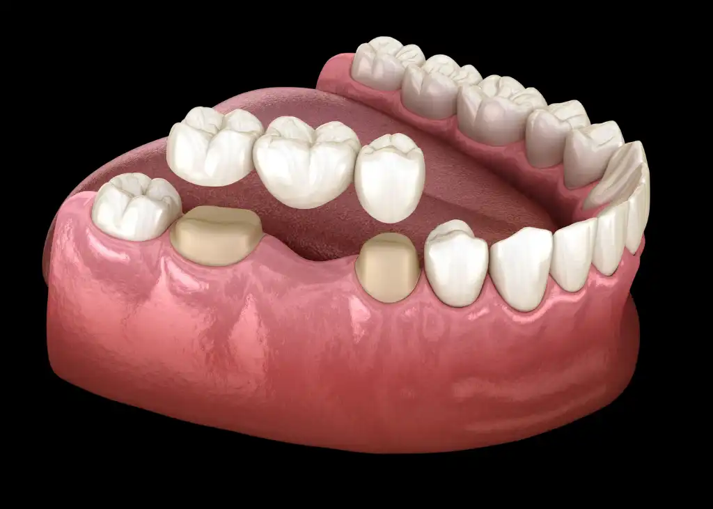 Dental crown before