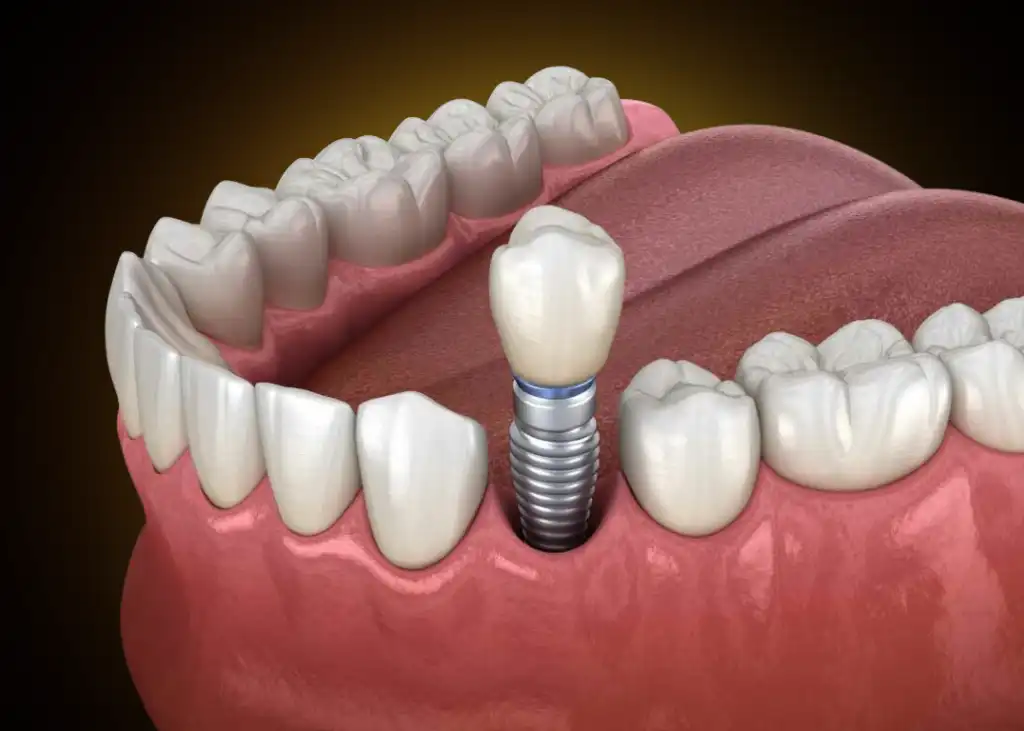 Implant after