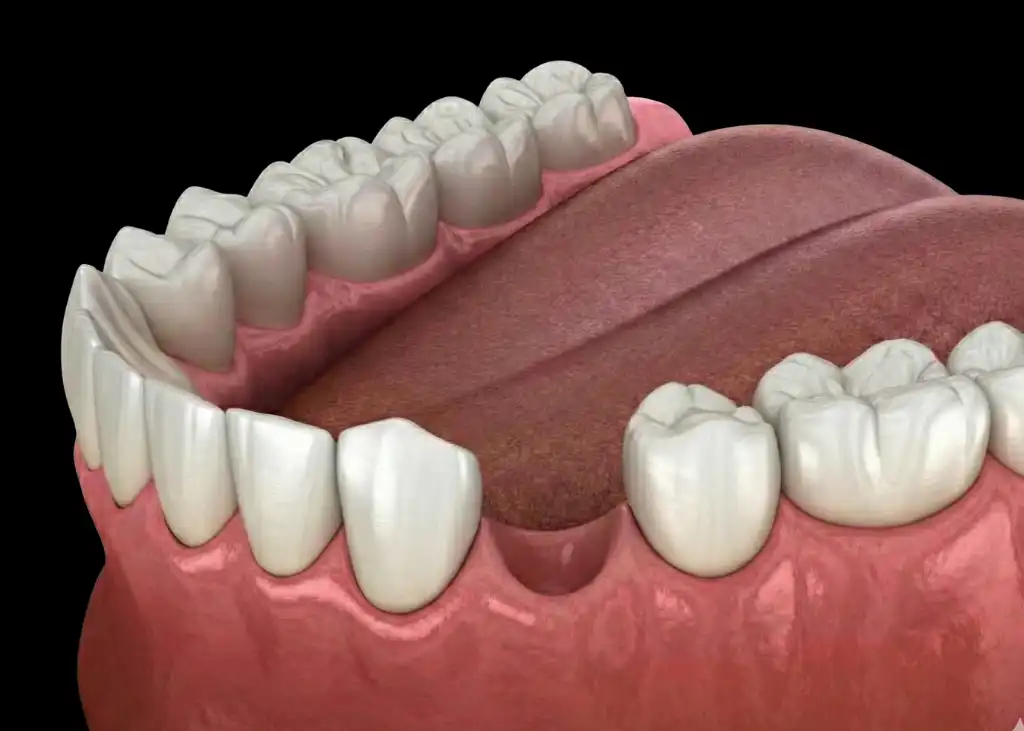 Implant before
