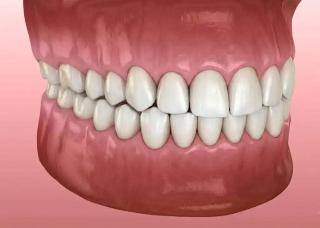 Invisalign after