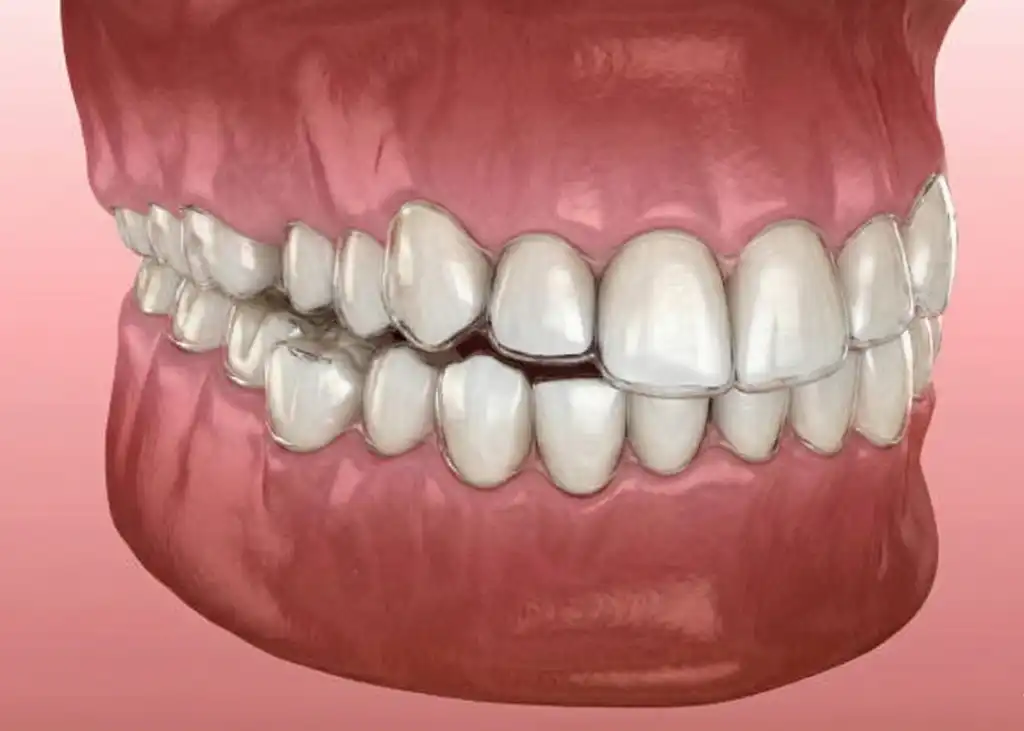 Invisalign before