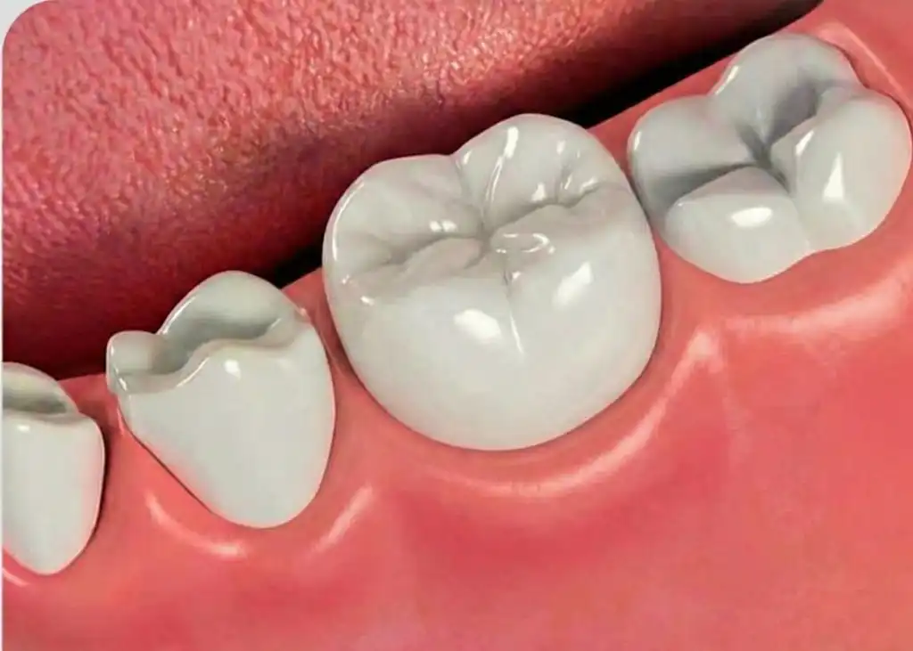 Root canal after