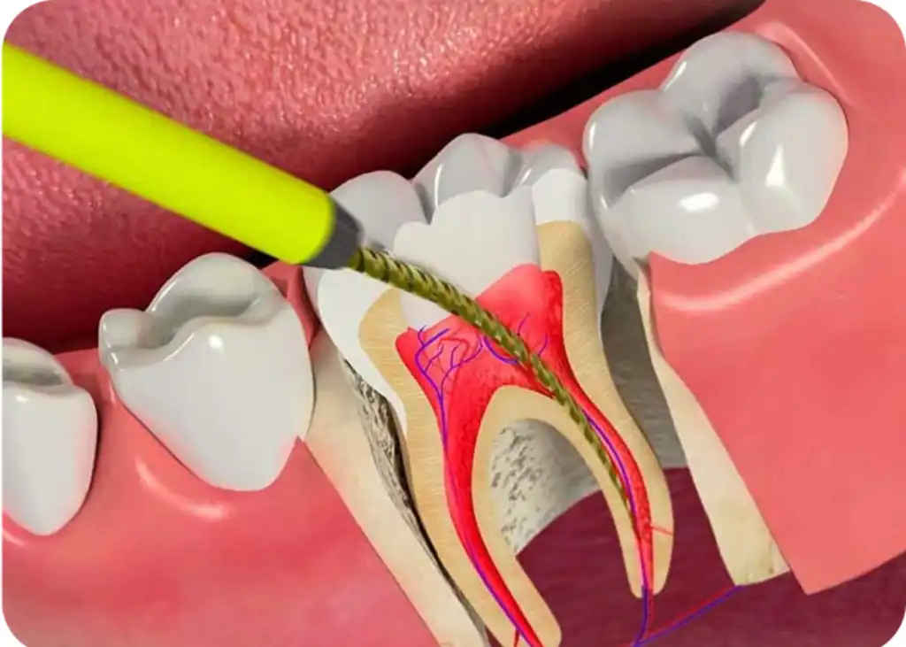 Root canal before