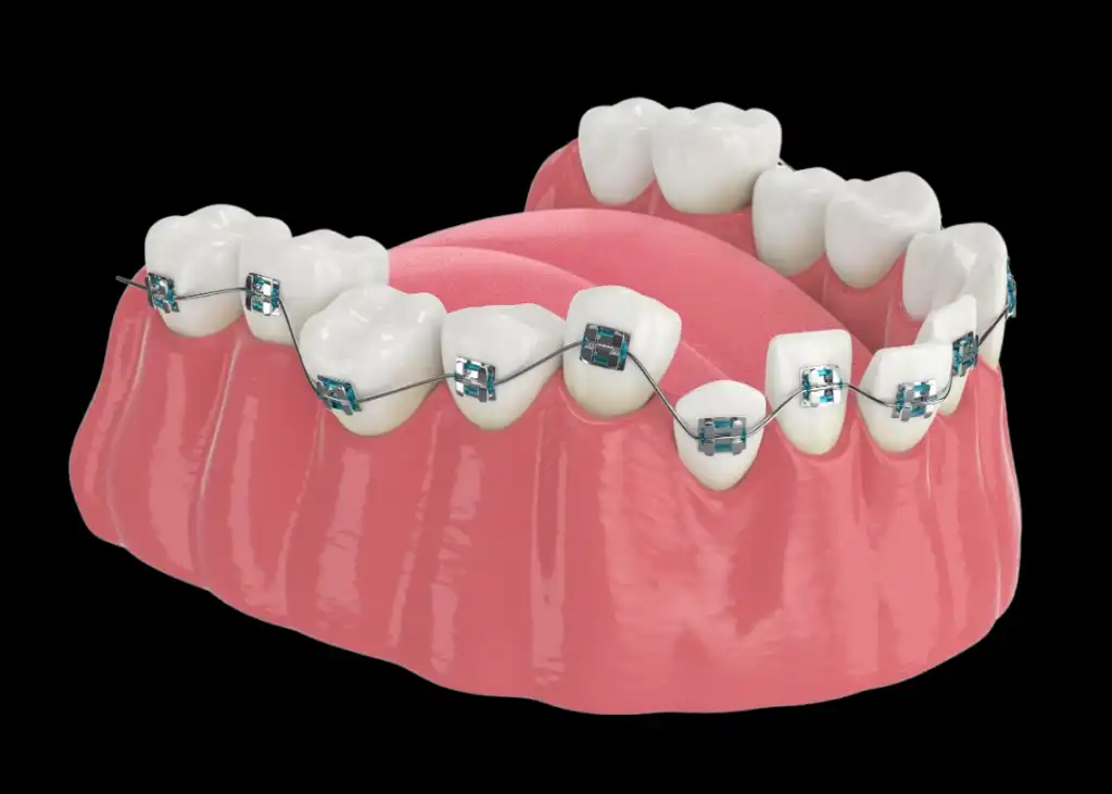 Braces before