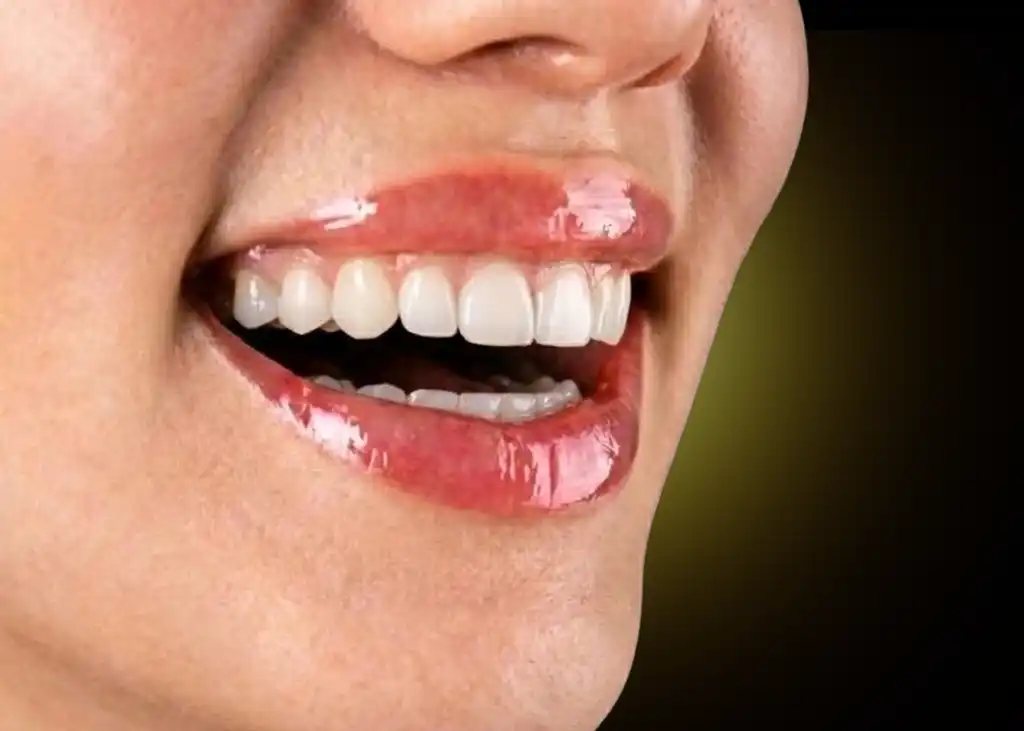 Gap filling after