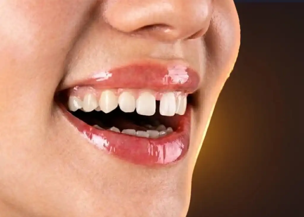 Gap filling before