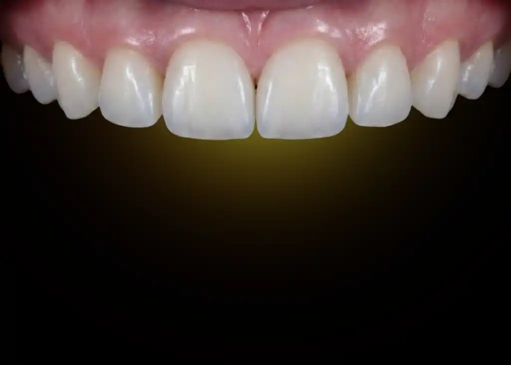 Smile design after