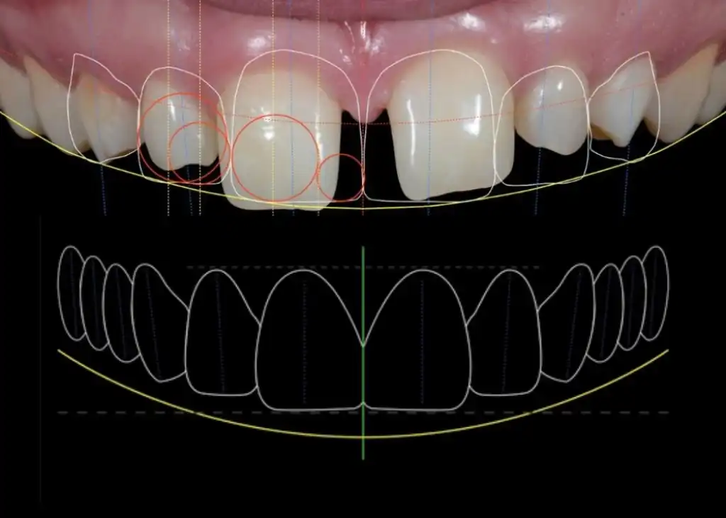 Smile design before