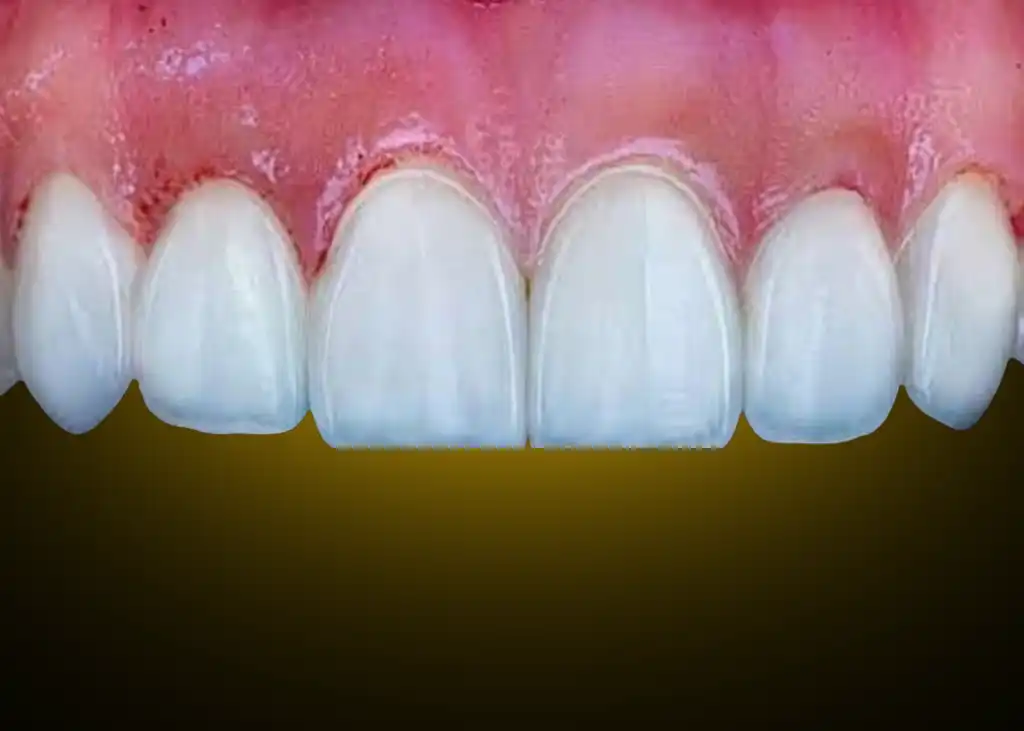 Veneers after