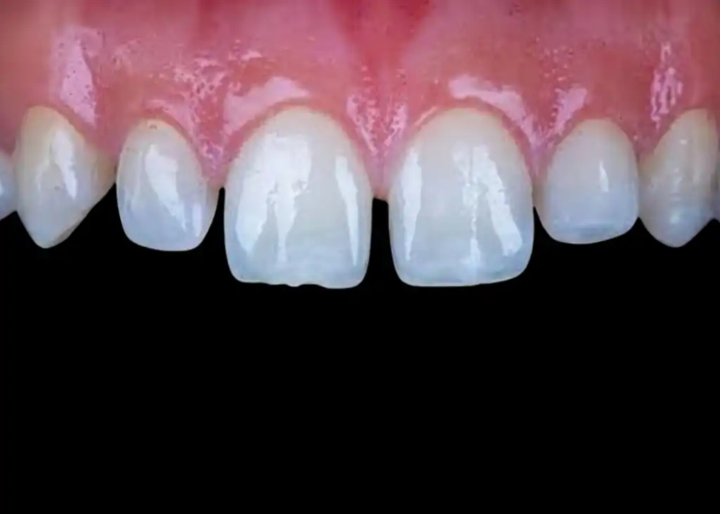 Veneers before