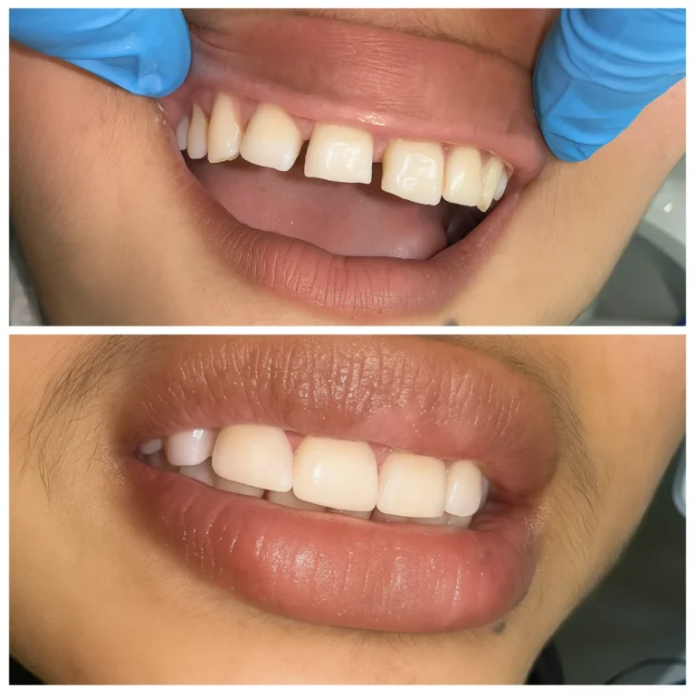 Flawless Smile Design Gap Closure at the Best Dental Clinic in Uttara