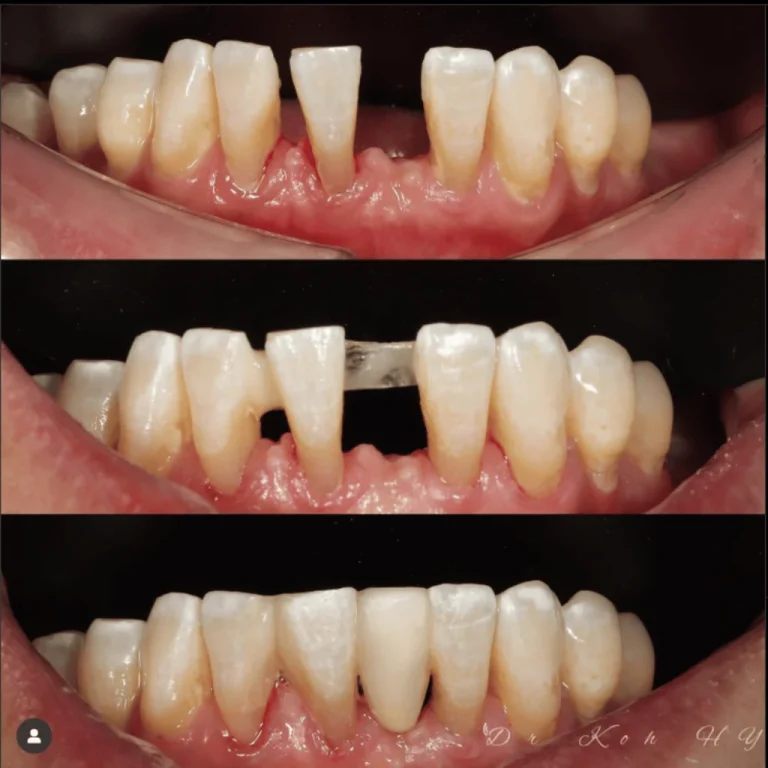 Lower Teeth Dental Bridge Restoration