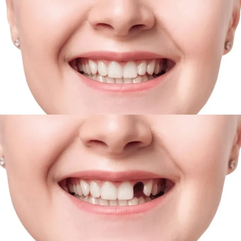 Before and after smile comparison of a missing lateral incisor replaced with a natural-looking dental implant. Procedure performed by Prof. Dr. Nafees Uddin Chowdhury at Tech Dental, the best dentist and leading dental clinic in Badda.
