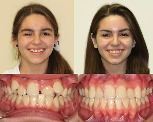 Orthodontist treatment Before after image