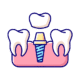 dental-implant